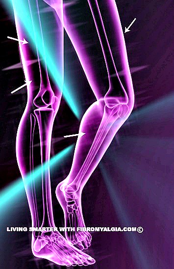 Dolor muscular crónico (en azul) Fibromialgia Dolor muscular crónico