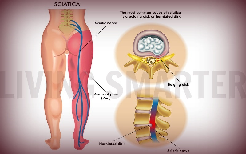 Fibromyalgia and Sciatica Pain – Does One 
Cause the Other?