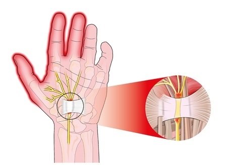 Carpel Tunnel Syndrome - Hand Illustrated